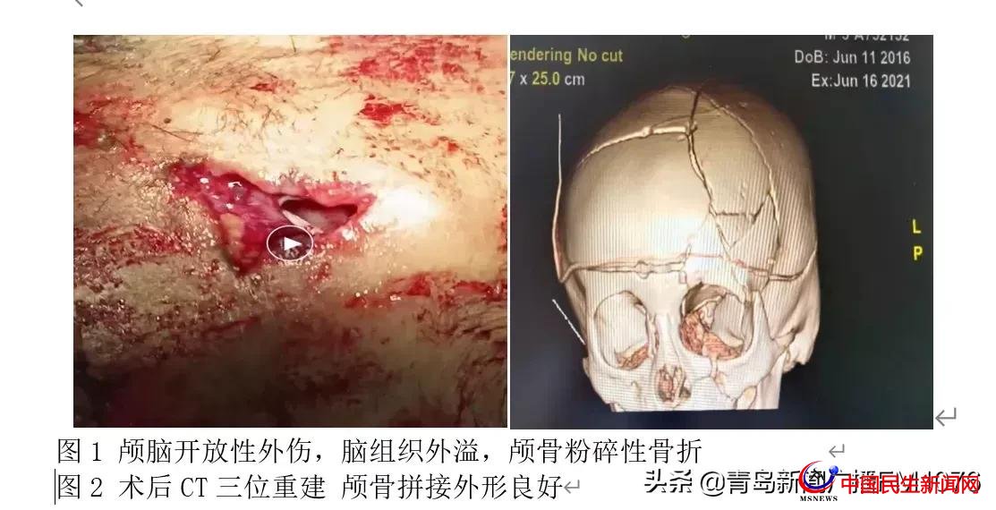 5歲男童6樓墜落命懸一線,婦兒醫(yī)院多學科協(xié)作再勝“死神”